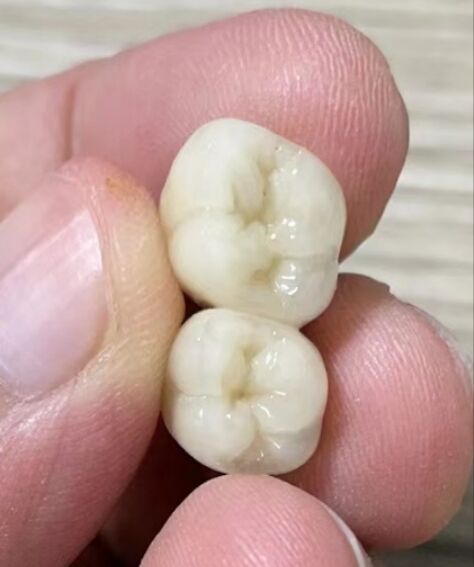 定制式活动义齿出口加拿大MDL认证 加拿大假牙代加工